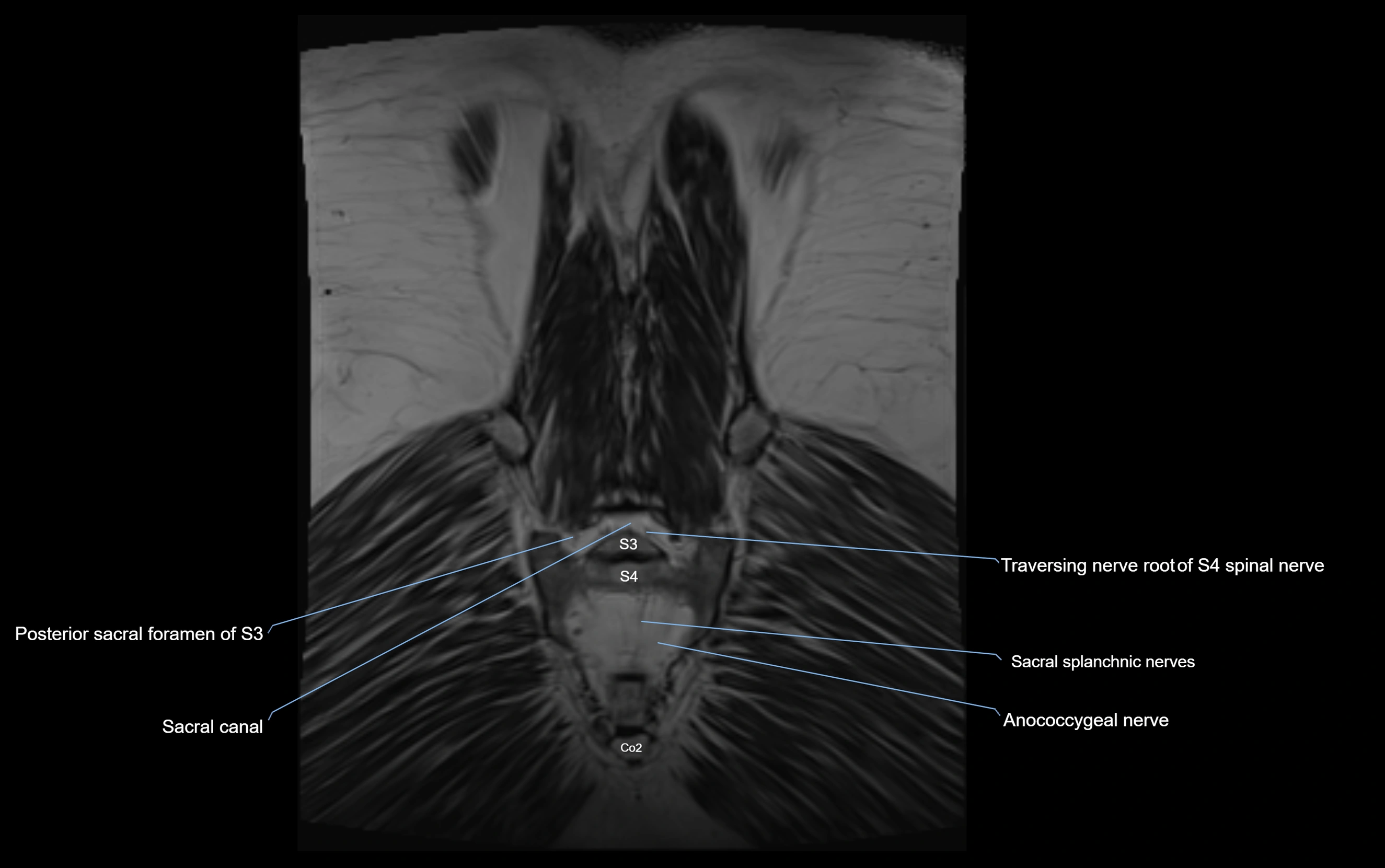 MR lumbosacral plexus cross sectional anatomy 3T  radiology  image-img-09001-00078.webp